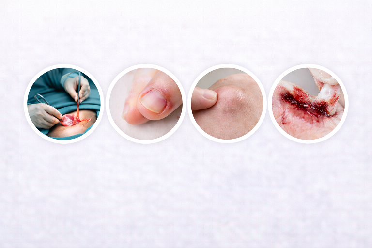 กลุ่มอาการที่เหมาะกับแพ็กเกจศัลยกรรมเล็ก เช่น ฝี หนอง แผลลึก เล็บขบ