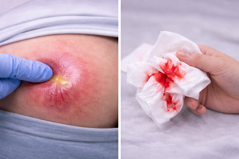 อาการฝี หนอง หรือแผลติดเชื้อที่ควรมาพบแพทย์