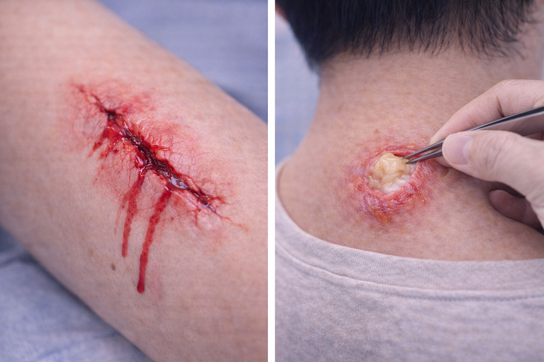 ลักษณะแผลที่ควรเย็บแผลหรือพบแพทย์ทันที
